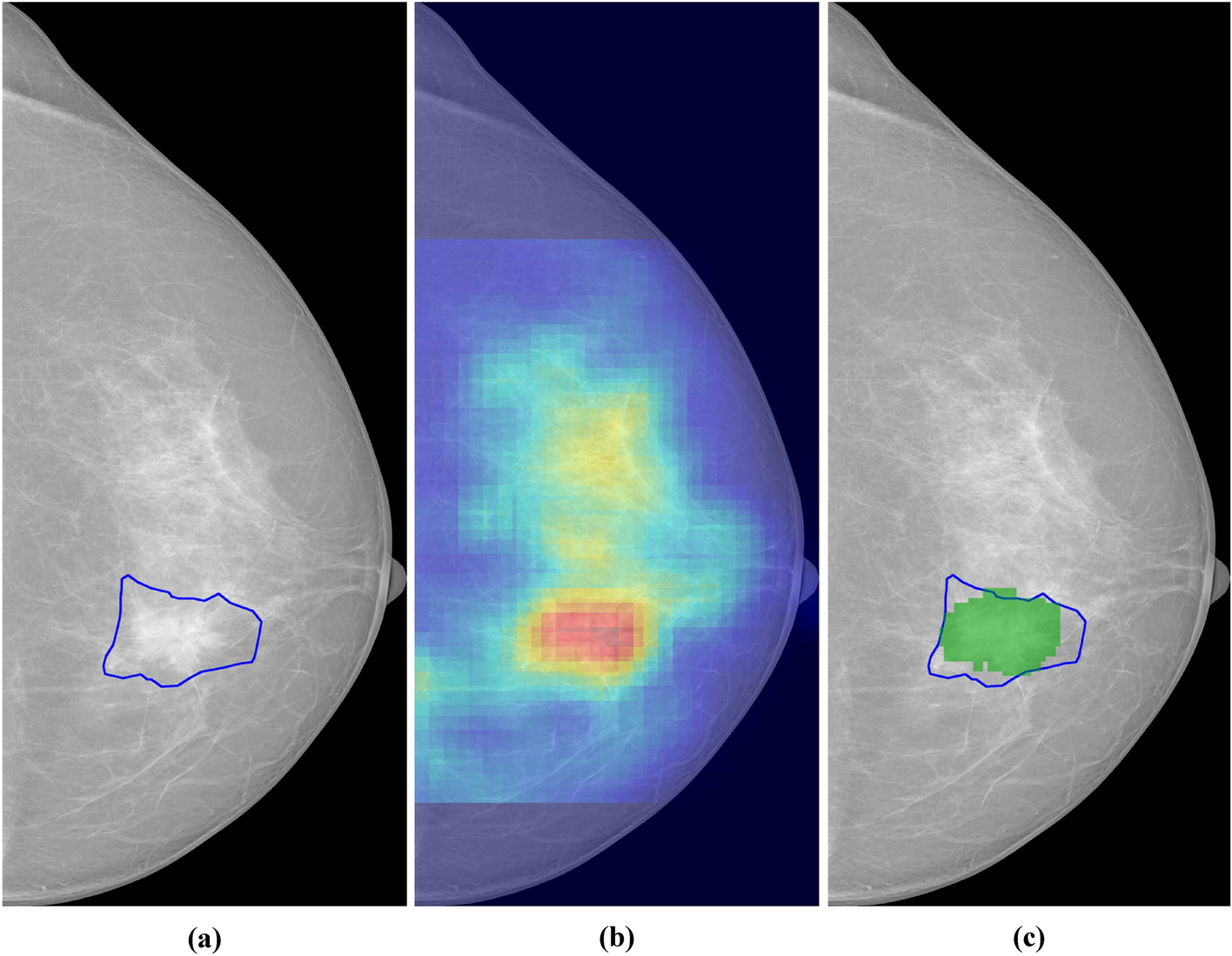 Saliency of breast lesions in breast cancer detection using artificial intelligence | Scientific Reports