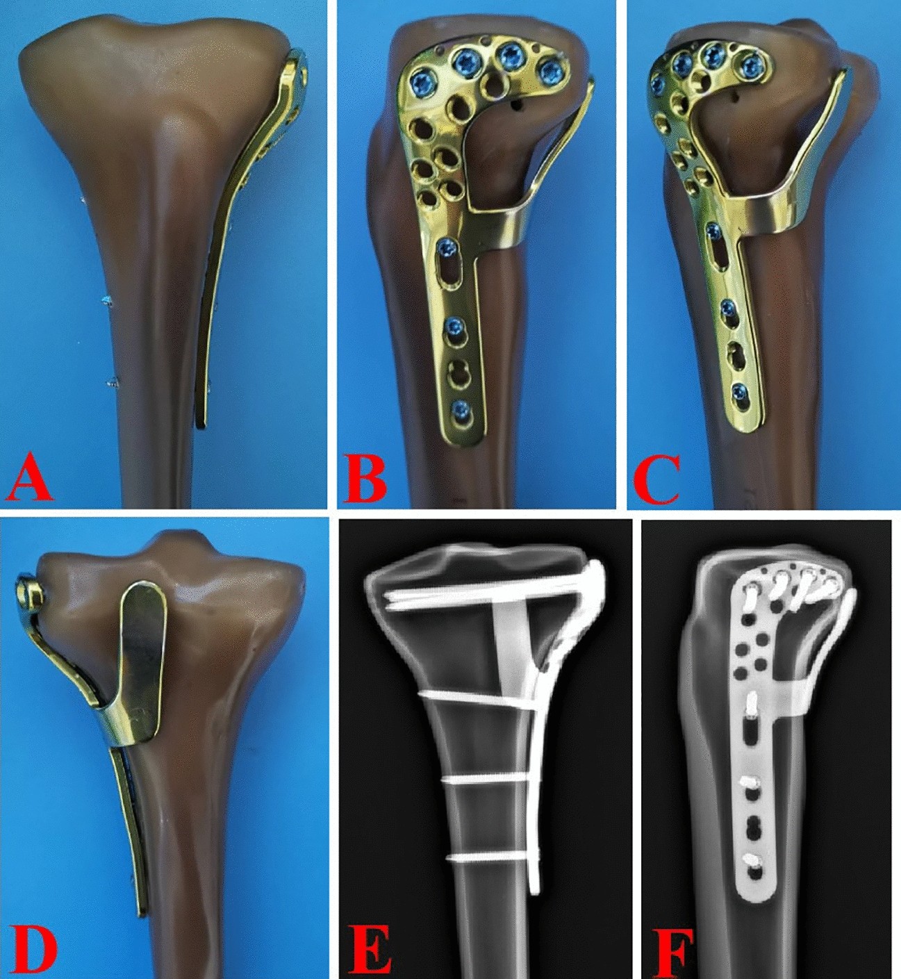 Titanium elastic nail is orthopedic implants used in surgery