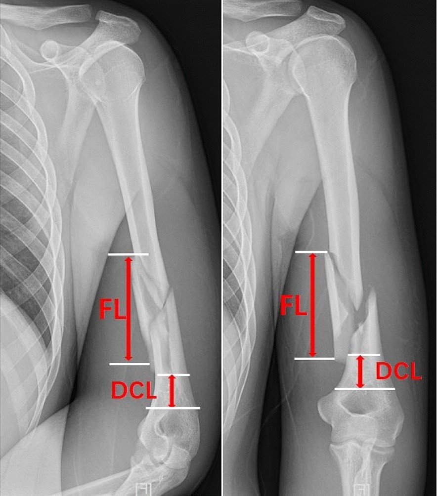 Current trends in the management of proximal humerus fractures in elderly  patients | Lo Scalpello - Journal