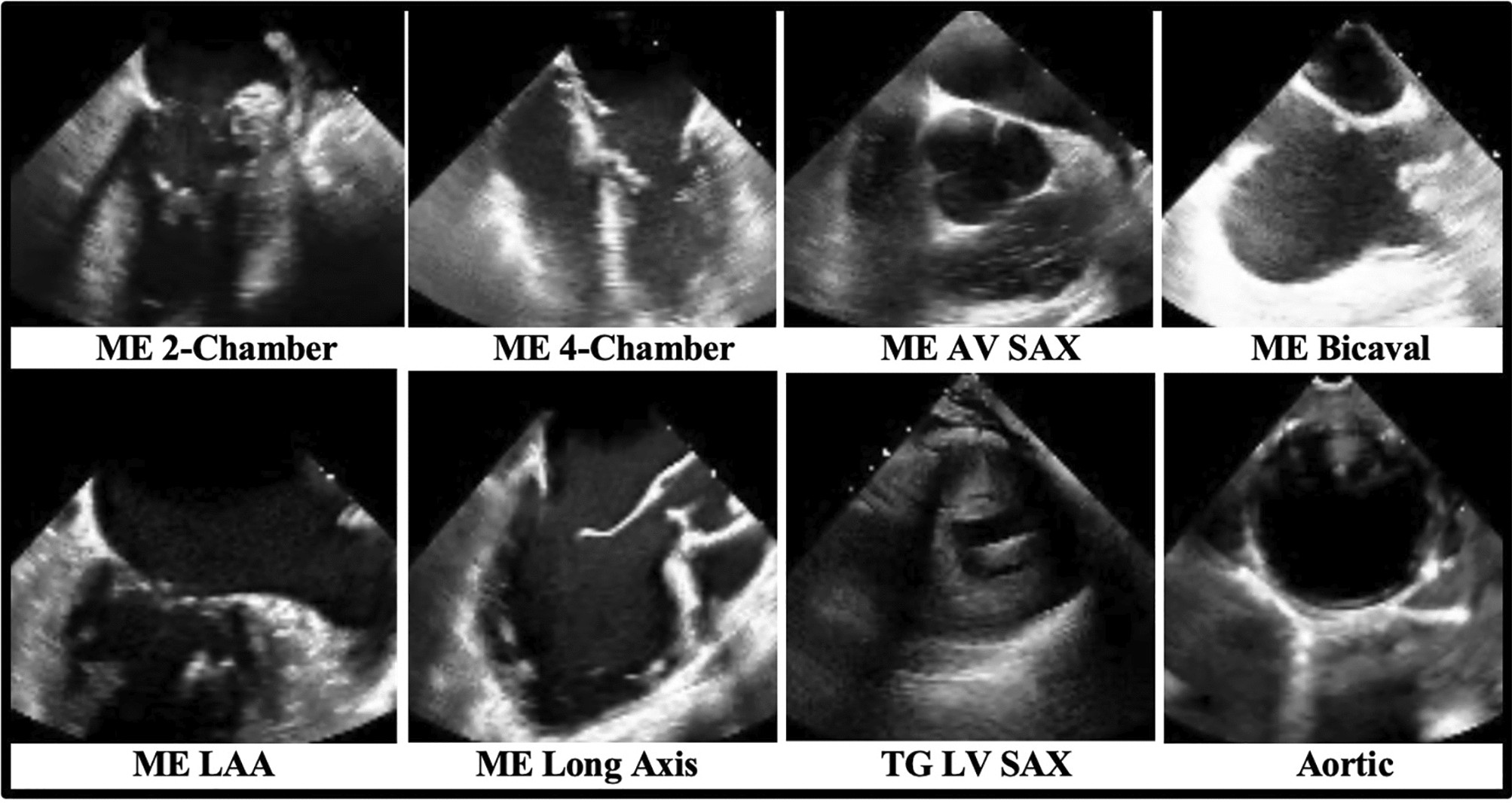 About Your Transesophageal Echocardiogram (TEE)