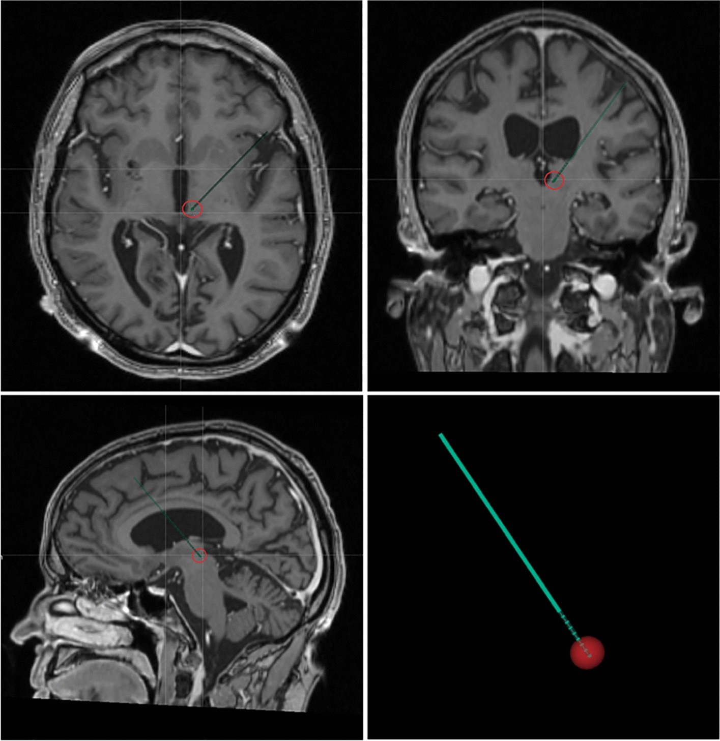 brain scan showing neurological activity with deep pressure stimulation