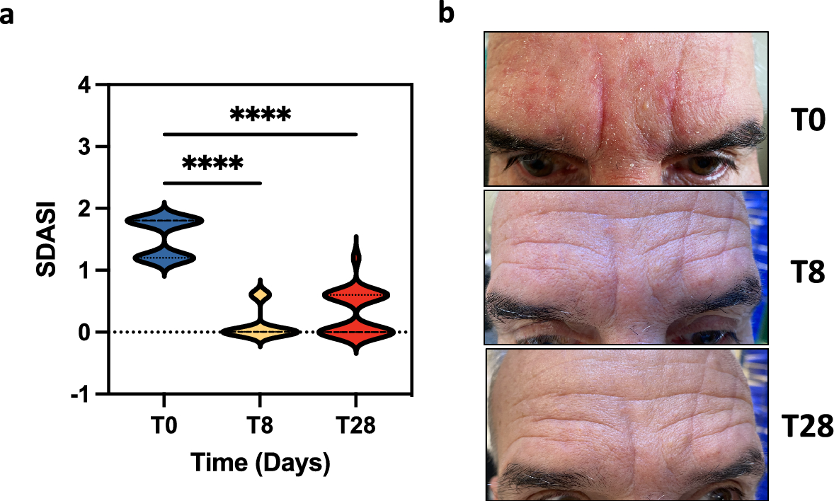 Modulating the skin mycobiome-bacteriome and treating seborrheic dermatitis  with a probiotic-enriched oily suspension