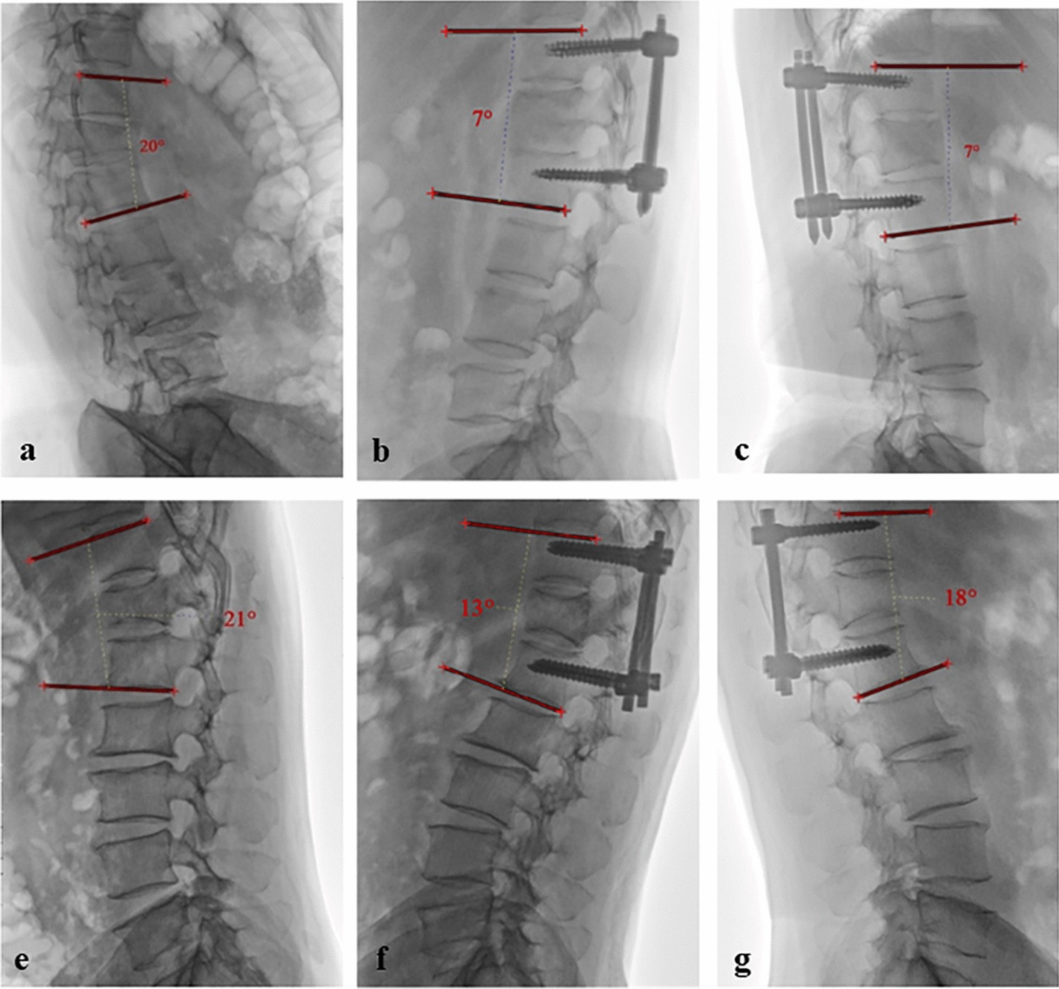 Association between paraspinal muscle fat infiltration and regional  kyphosis angle in thoracolumbar fracture patients: a retrospective study