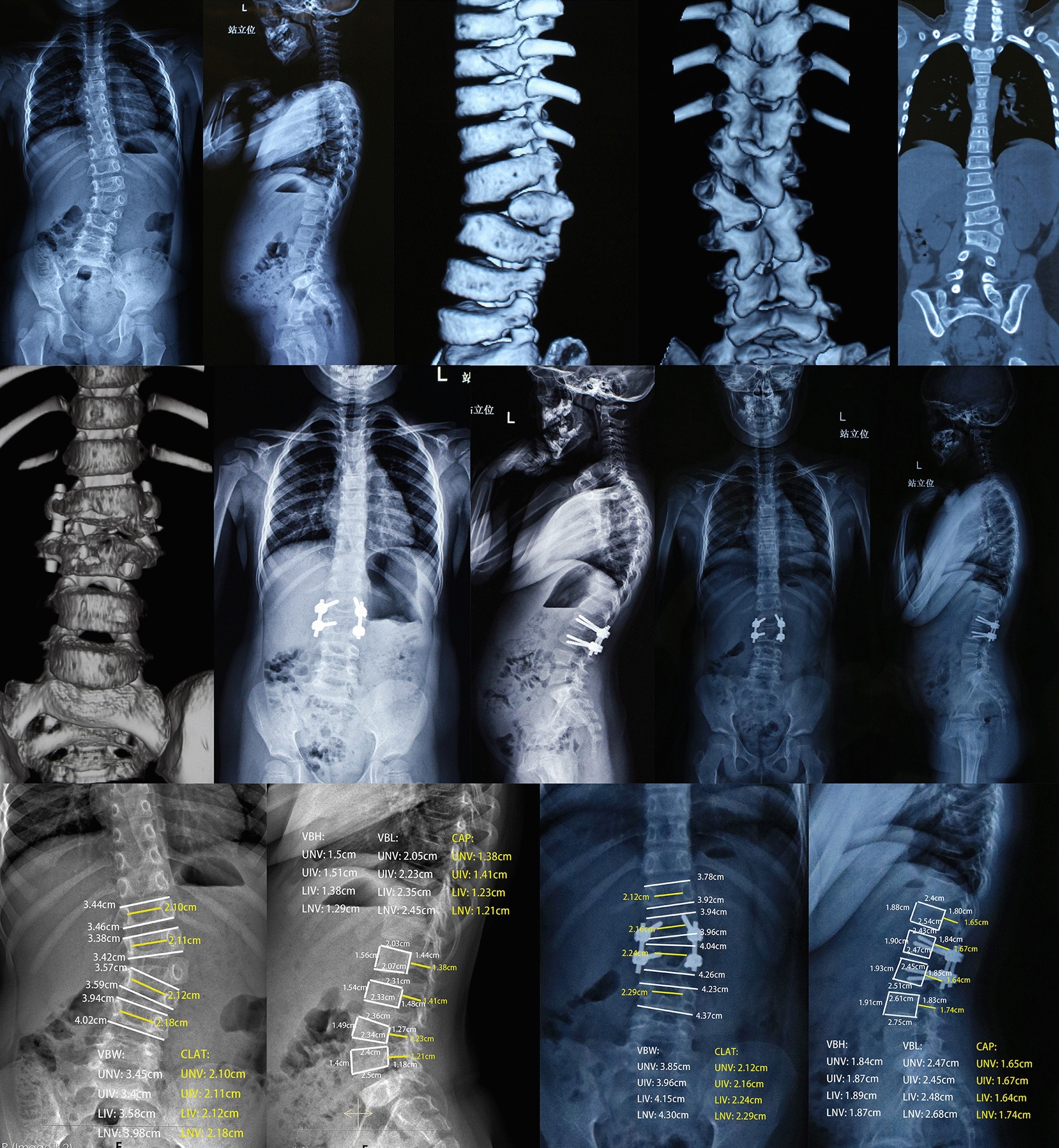 Clinical outcomes and spinal growth after posterior hemivertebra resection  and short segment fusion in children