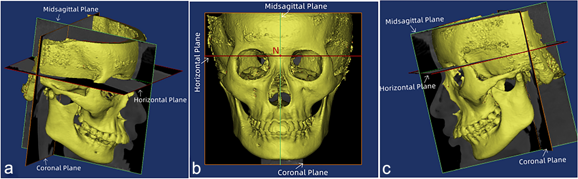 lsm.jpg4.us | imagesize: lmc-018" Facial asymmetry of the hard and soft tissues in skeletal Class I, II, and  III patients | Scientific Reports