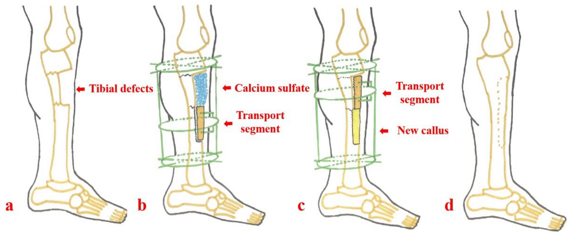 Semi-focal bone transport versus traditional bone transport 