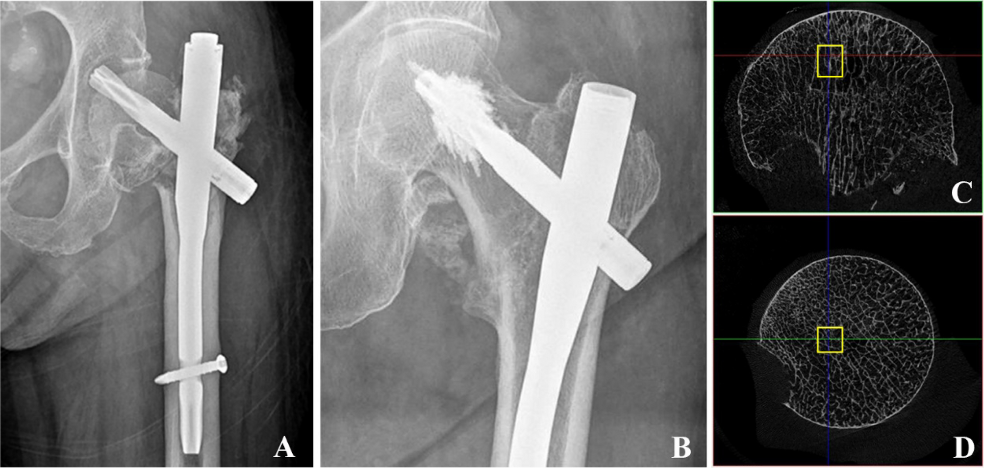 Finite element study on the micromechanics of cement-augmented proximal  femoral nail anti-rotation (PFNA) for intertrochanteric fracture treatment  | Scientific Reports