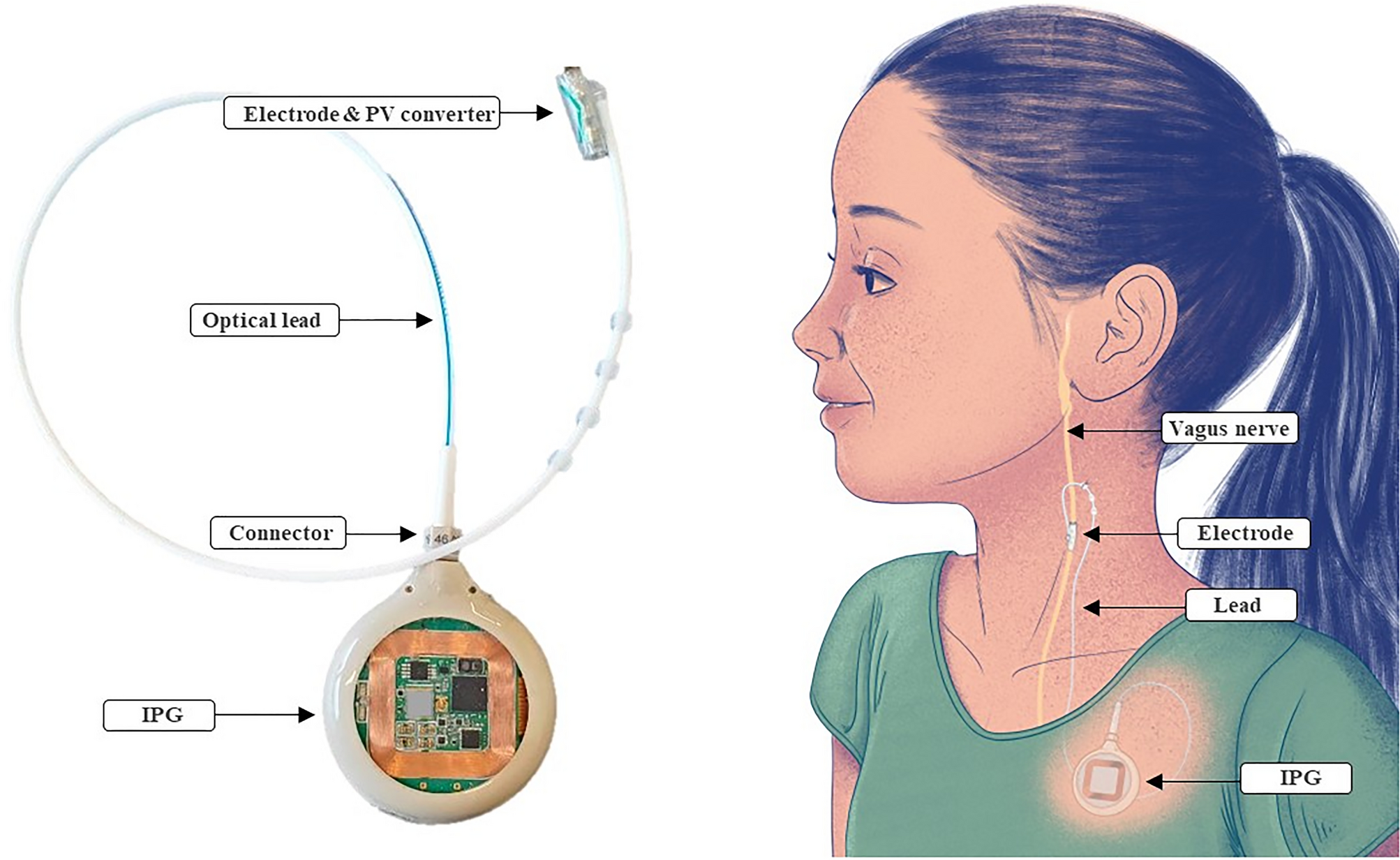 HD Electrodes