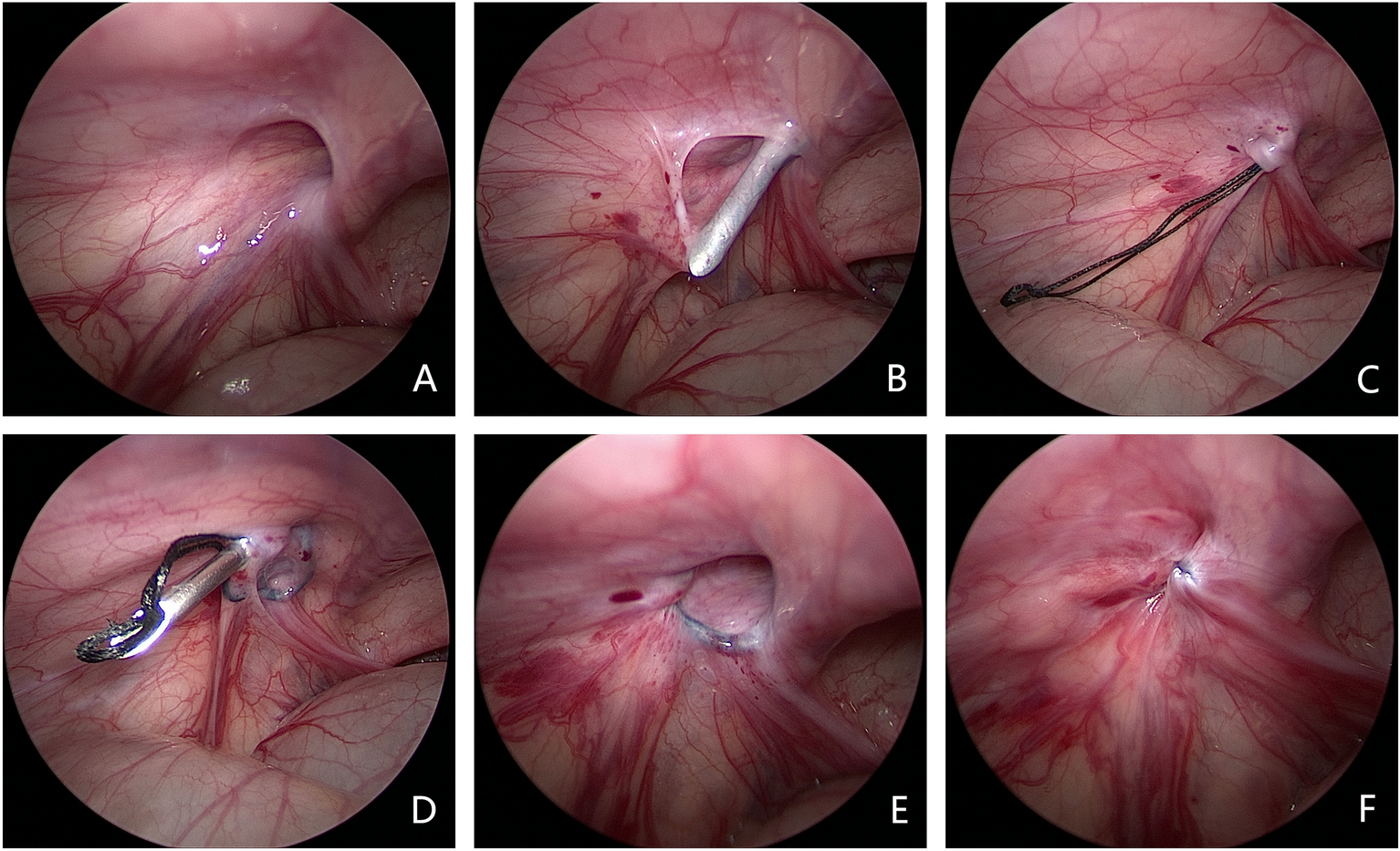 Outcomes from a new modified single needle laparoscopic 
