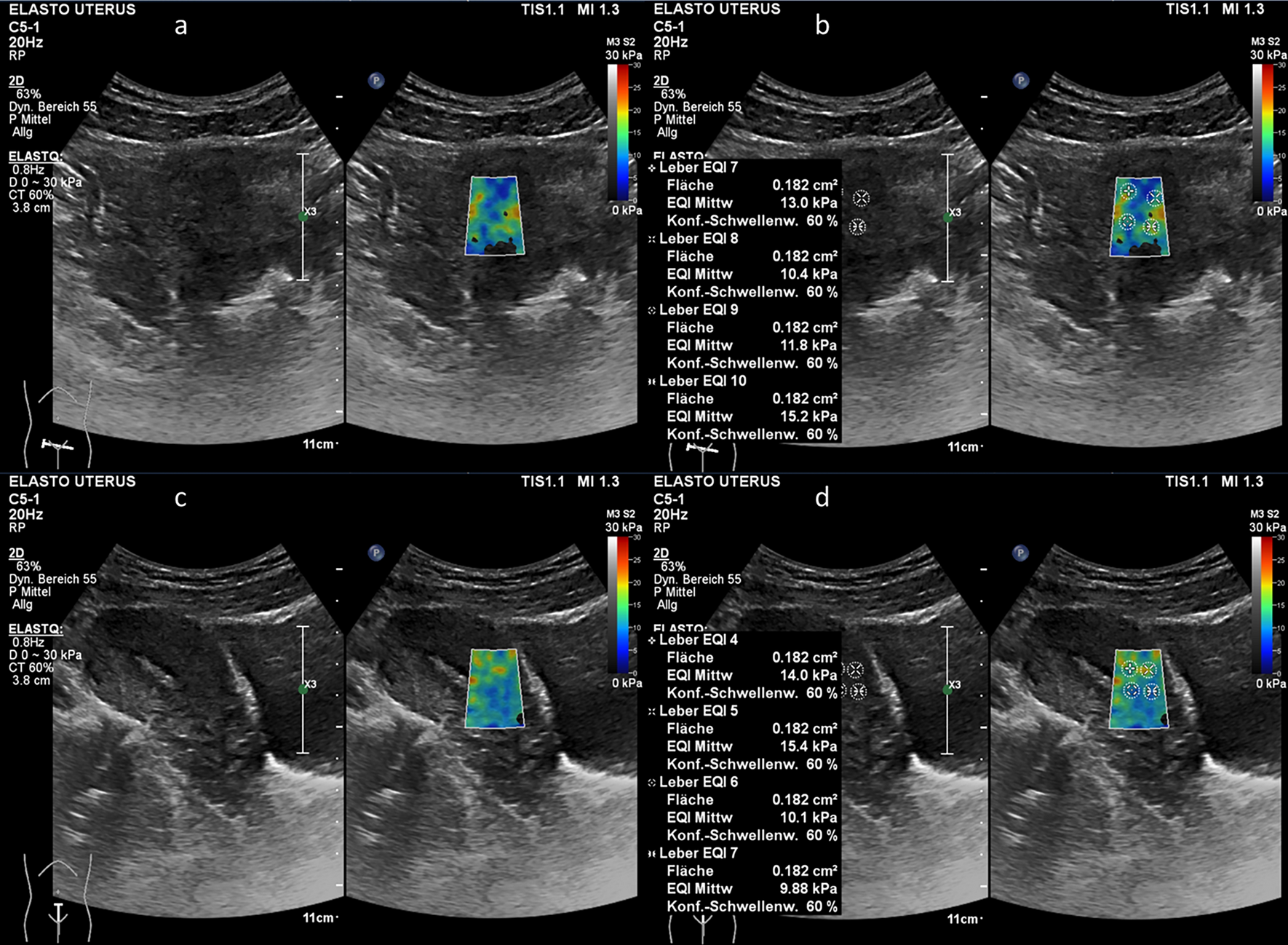 Clinical experience with shear wave elastography (SWE) for assessing  healthy uterus in a transabdominal approach | Scientific Reports