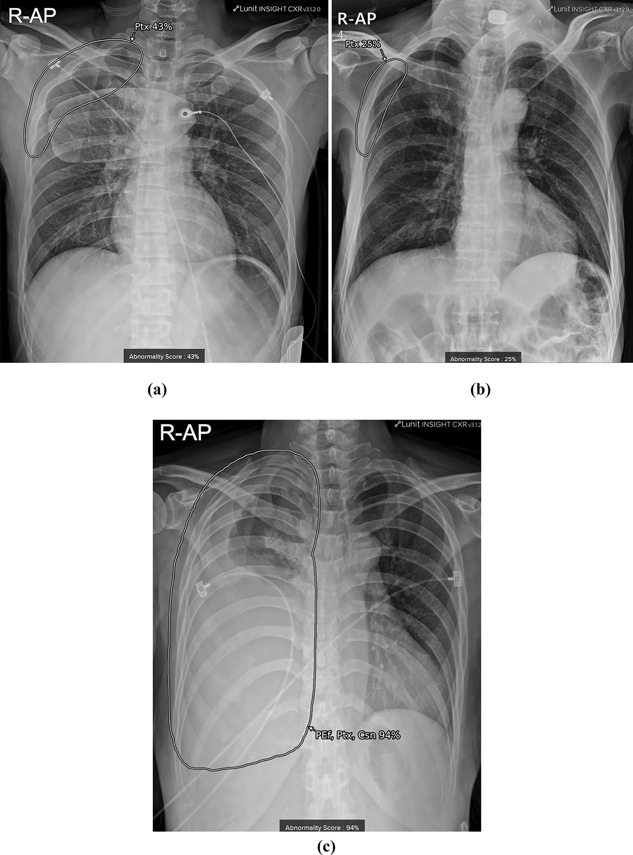 Factors for increasing positive predictive value of pneumothorax 