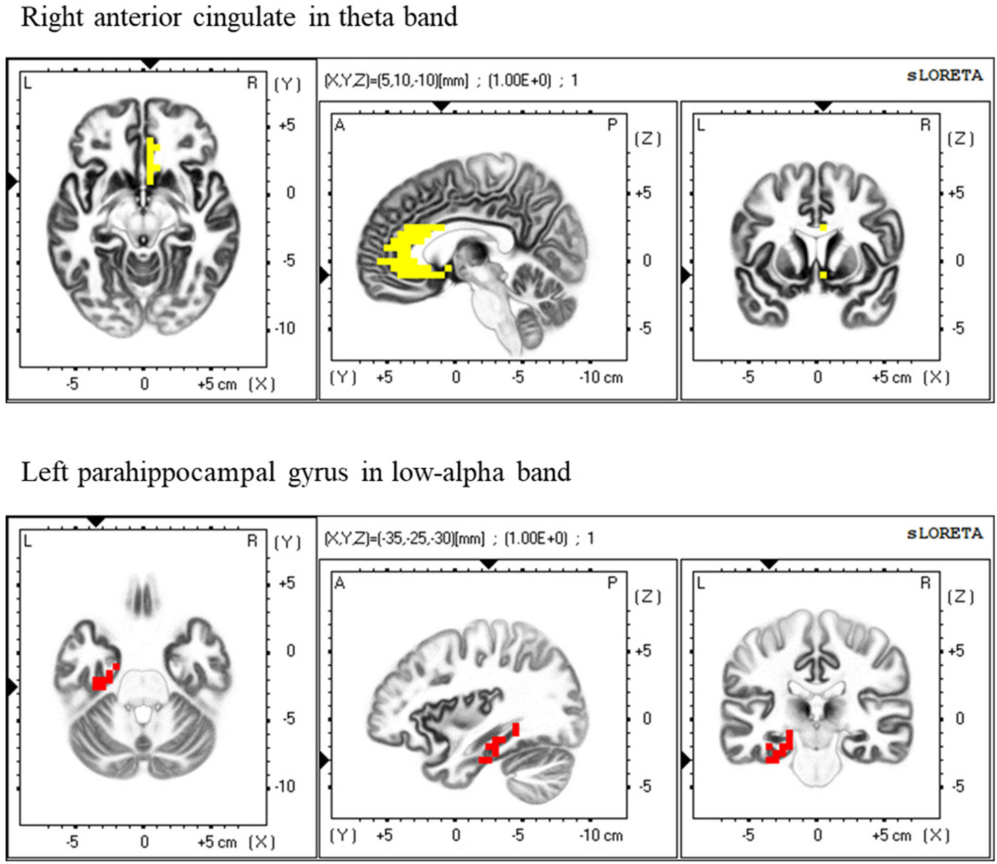 Electroencephalography-based endogenous phenotype of diagnostic 