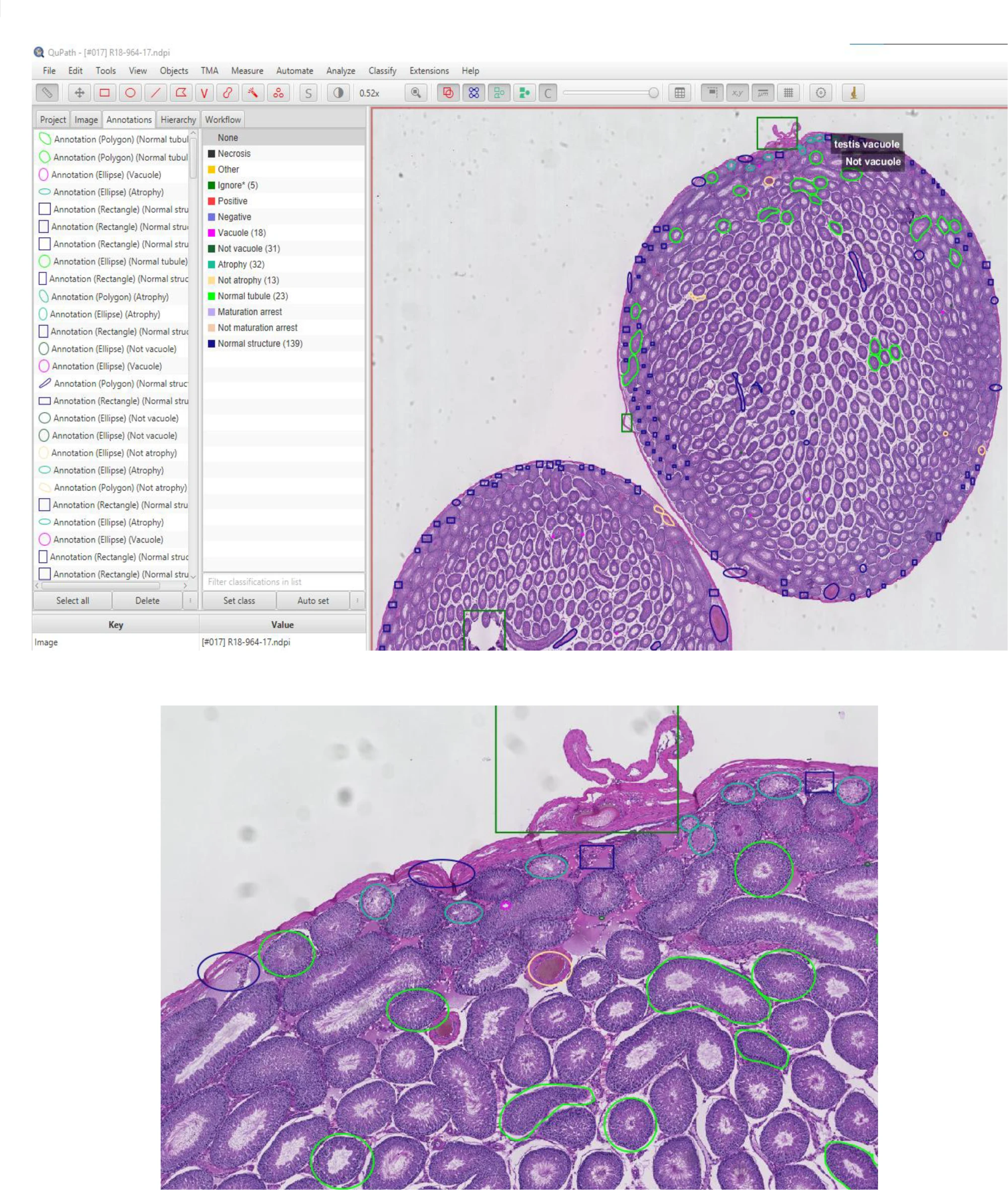 Example of a testis tissue image viewed in the QuPath system. Various regions of pathology have been human annotated in the image. The bottom image shows a zoomed in section from the top image that more clearly shows the annotations. For example, the light green annotations identify normal tubules, and the mid annotations identify atrophy. The large dark green rectangle annotates an “ignore” region.