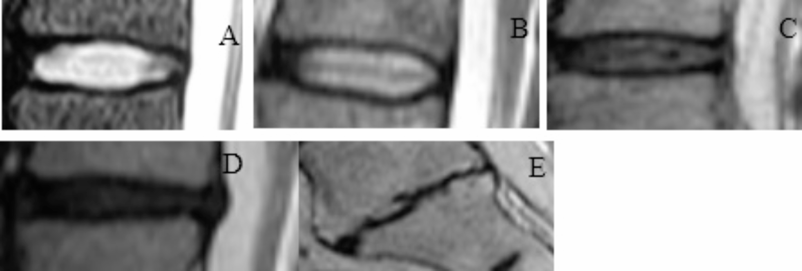 Imaging observation of intervertebral disc degeneration in patients with  old thoracolumbar fracture-related kyphotic deformity