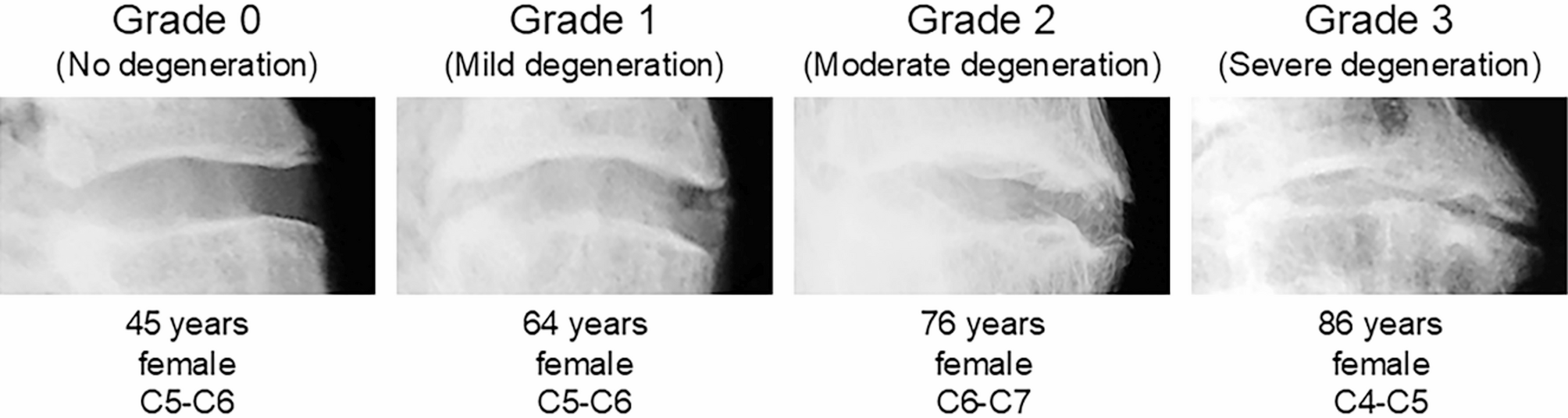 bpc-157 intervertebral disc degeneration study Intervertebral disc degeneration, age, and sex affect the range of motion  of the cervical spine