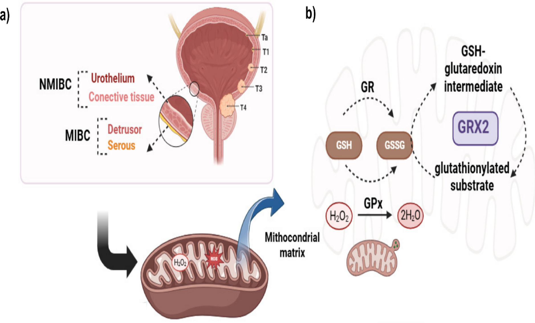GLRX2 polymorphism and oxidative stress levels impact urothelial bladder cancer outcomes