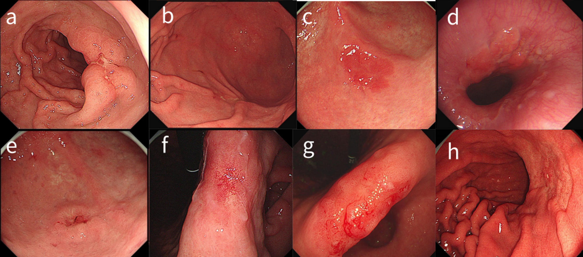 A nomogram for predicting non-curative resection in patients with early  gastric cancer based on white light imaging | Scientific Reports, image size:2008x887