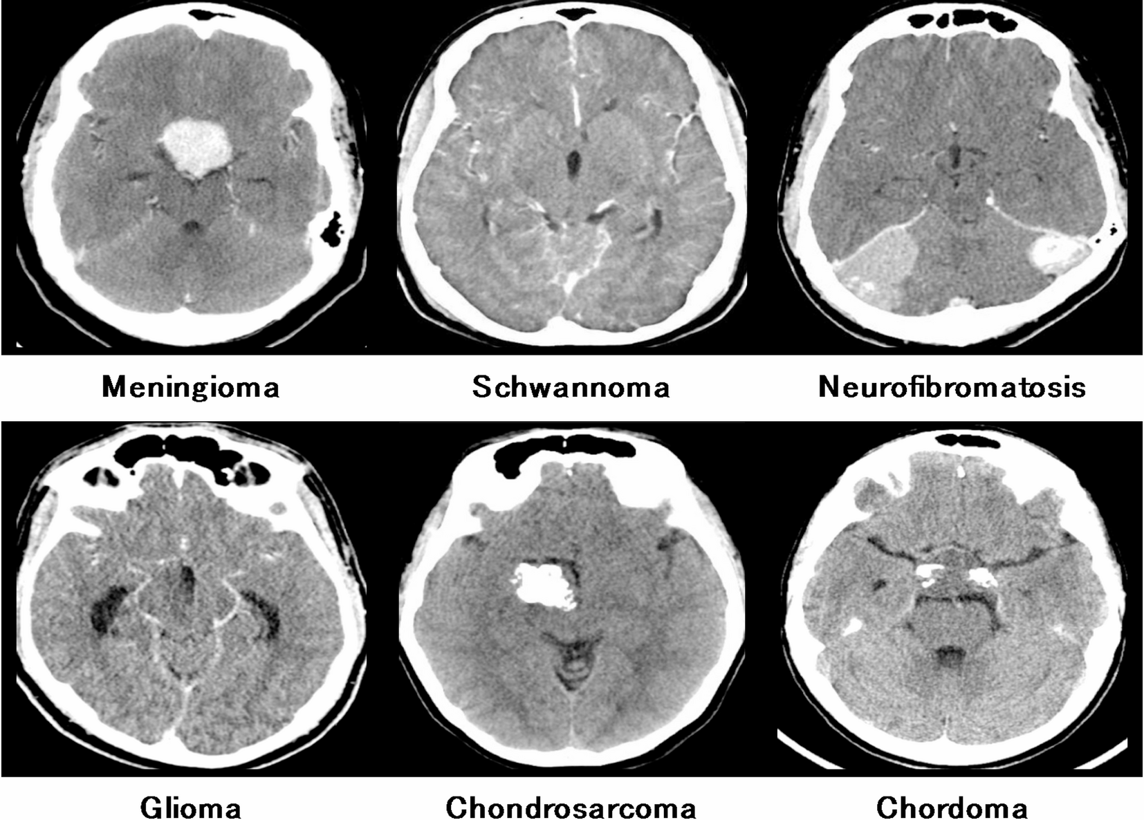Computer vision based efficient segmentation and classification of multi  brain tumor using computed tomography images | Scientific Reports