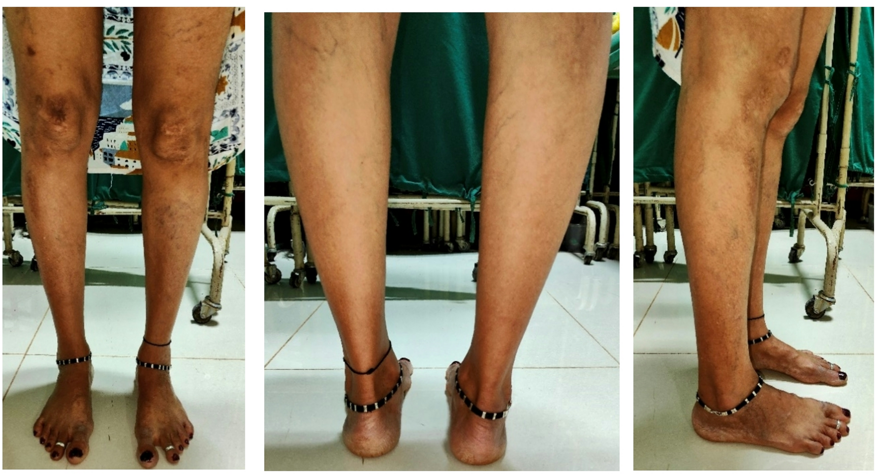 Foot posture as a biomechanical outcome measure following total knee  arthroplasty in individuals with severe knee osteoarthritis | Scientific  Reports