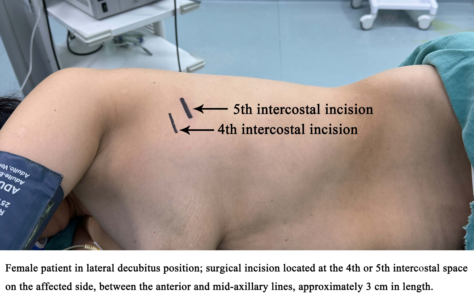 Clinical benefits of the 5th intercostal incision in uniportal VATS for  female patients | Scientific Reports, image size:2008x1242