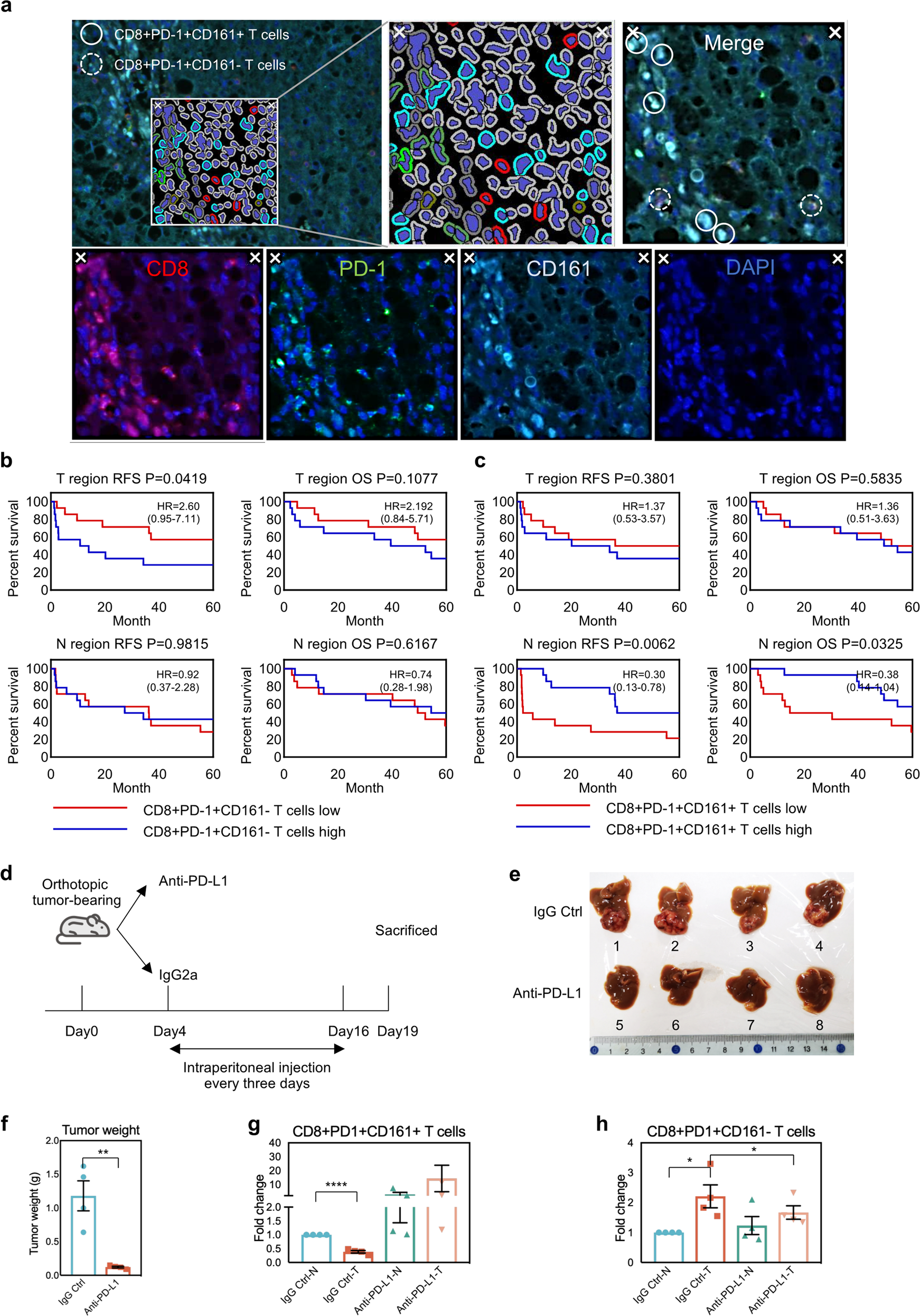 Fig. 4: The higher infiltration level of CD8+PD-1+CD161+ T cells indicates better prognosis.