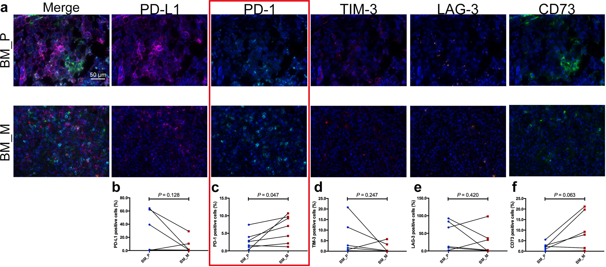 Fig. 6: Five immune checkpoints expression heterogeneity in tumor stroma of primary lesions and BM.