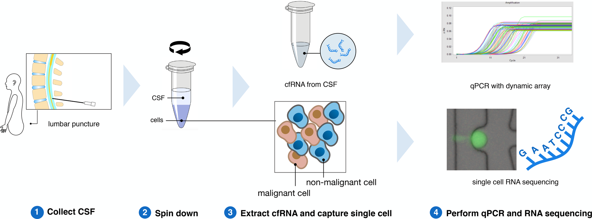 Figure, A cerebrospinal fluid (CSF) shunt] - PDQ Cancer Information  Summaries - NCBI Bookshelf