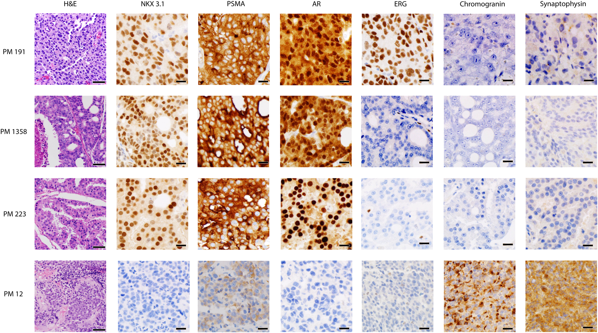 Copy number architectures define treatment-mediated selection of lethal  prostate cancer clones