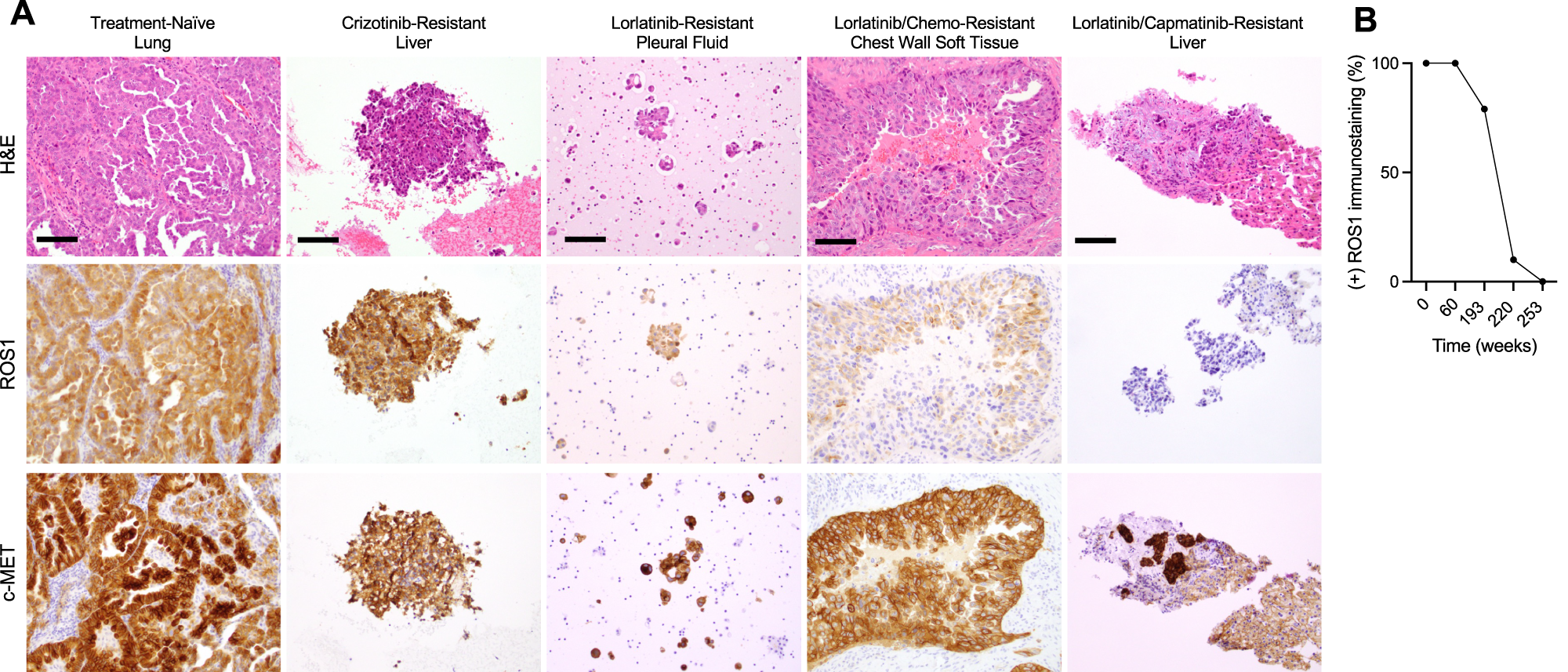 Fig. 2: ROS1 and MET protein expression during the treatment course.