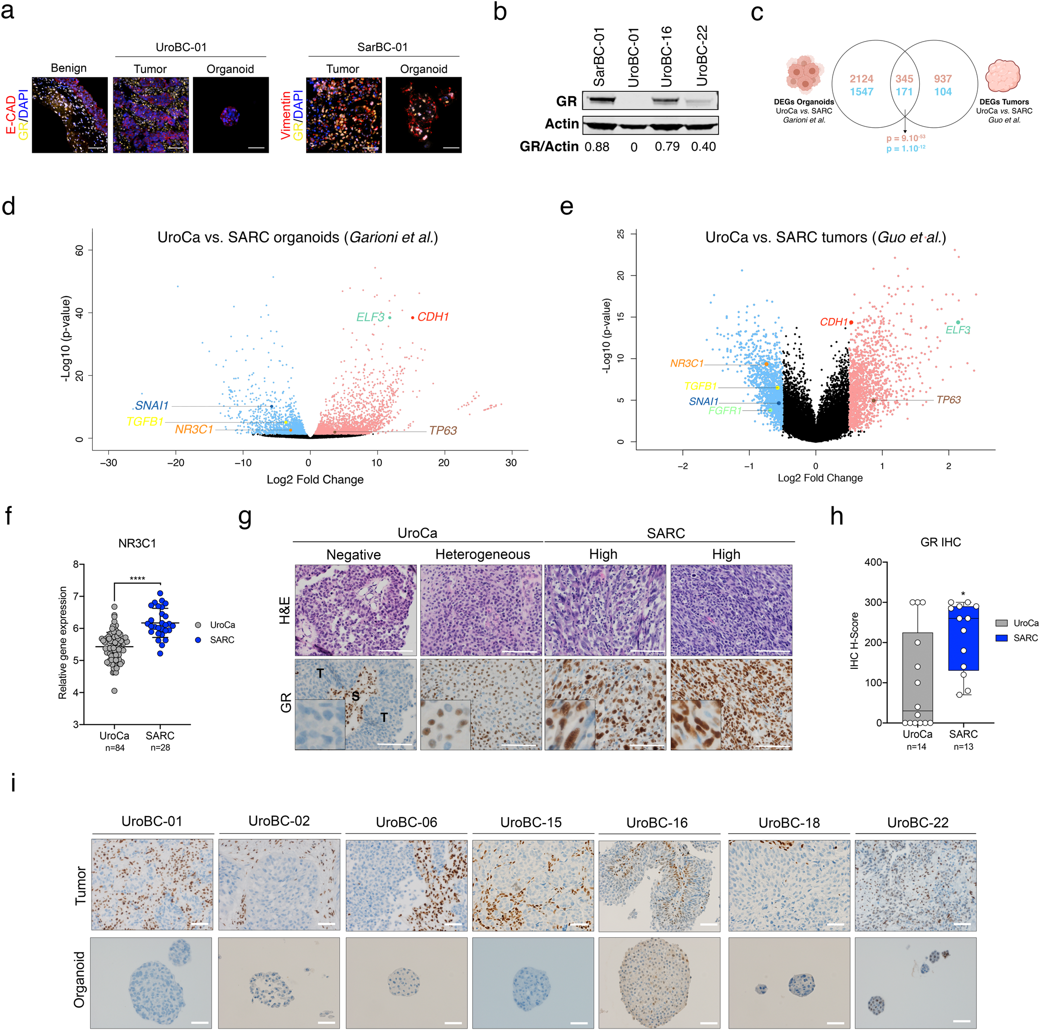 Fig. 4: Glucocorticoid Receptor (GR) is highly expressed in SARC.