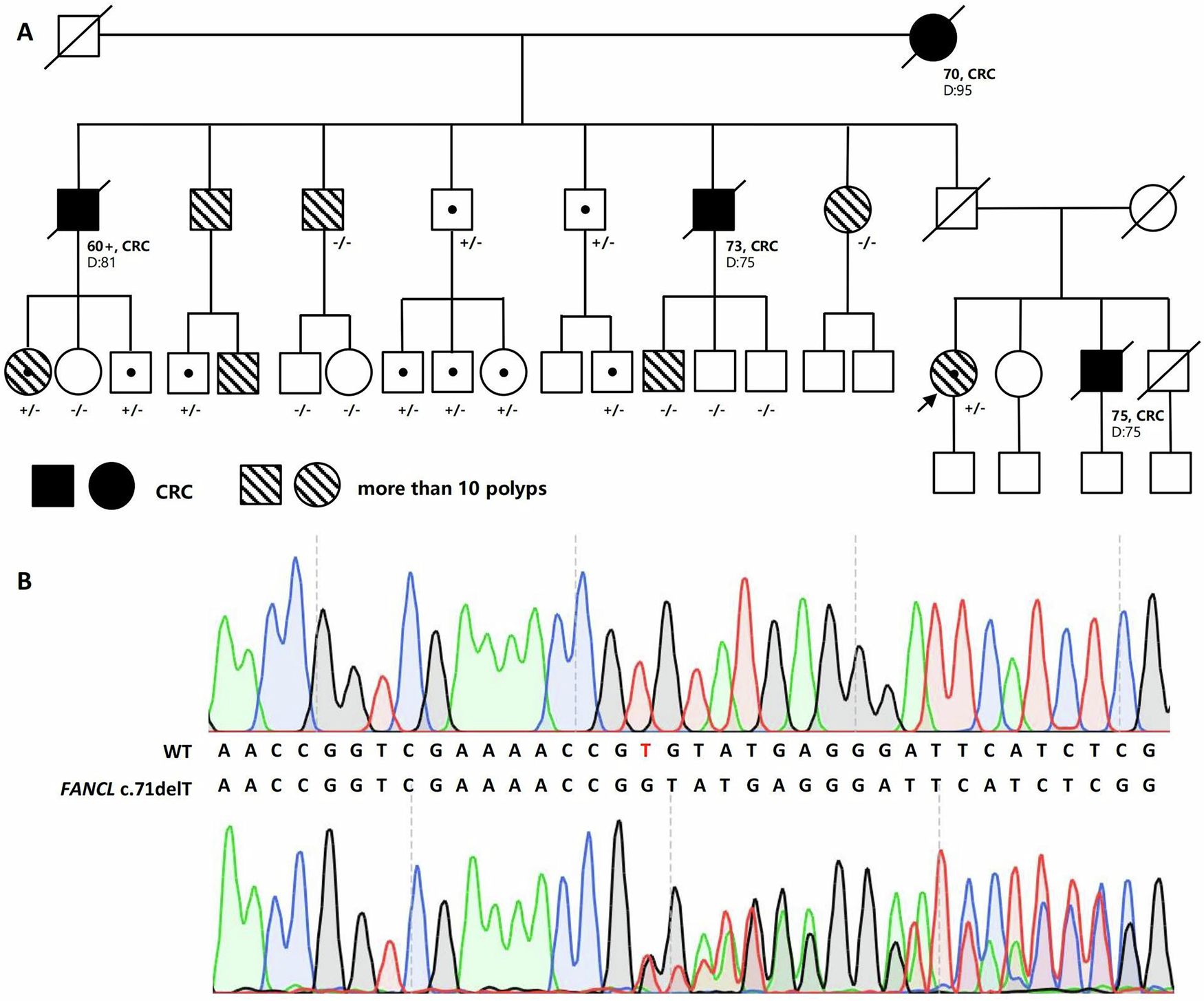 Fig. 5: Patient RK308 with likely pathogenic variants in the FANCL gene.