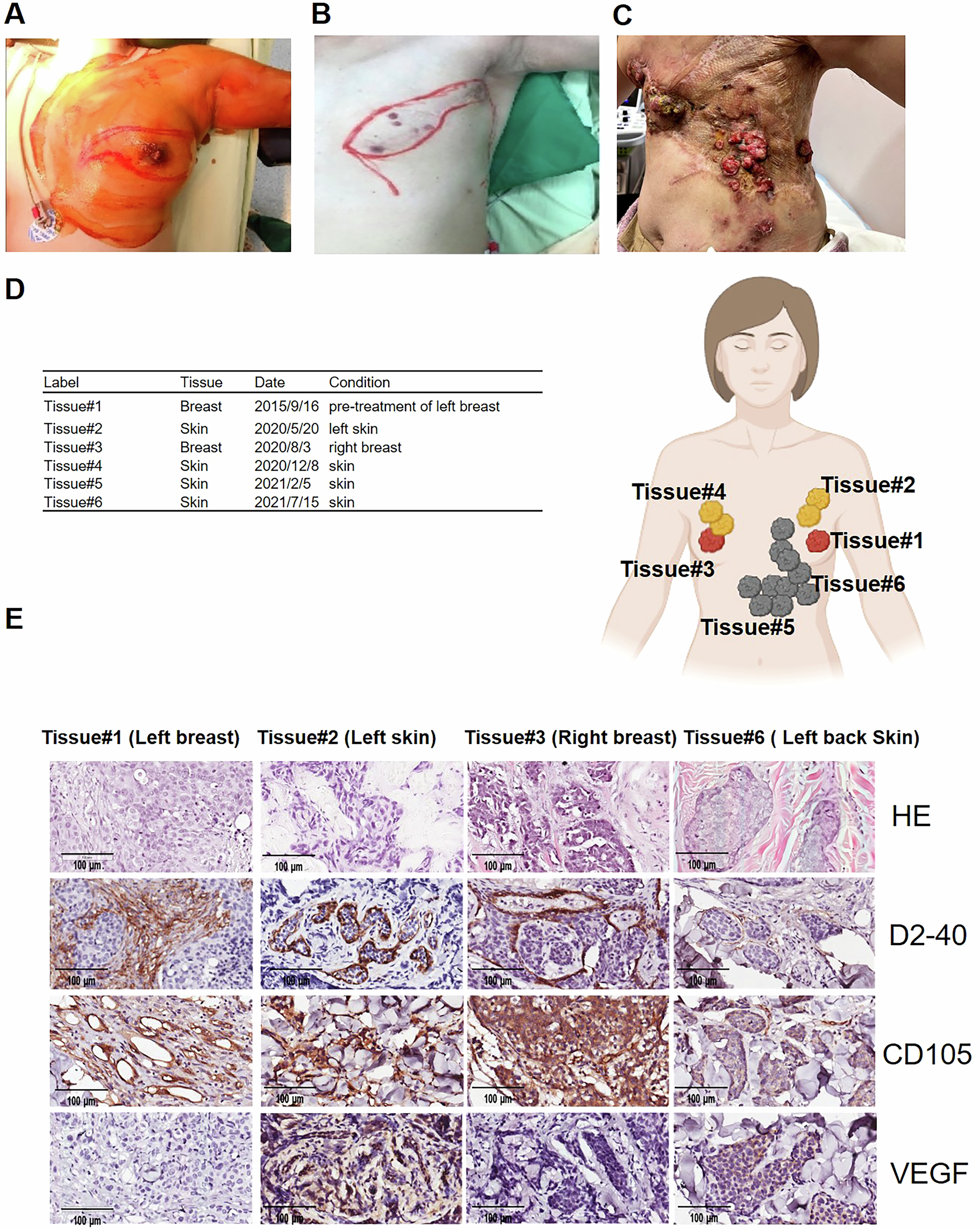 Fig. 2: CM is associated with increased angiogenic activity in primary tumors and metastatic skin lesions.