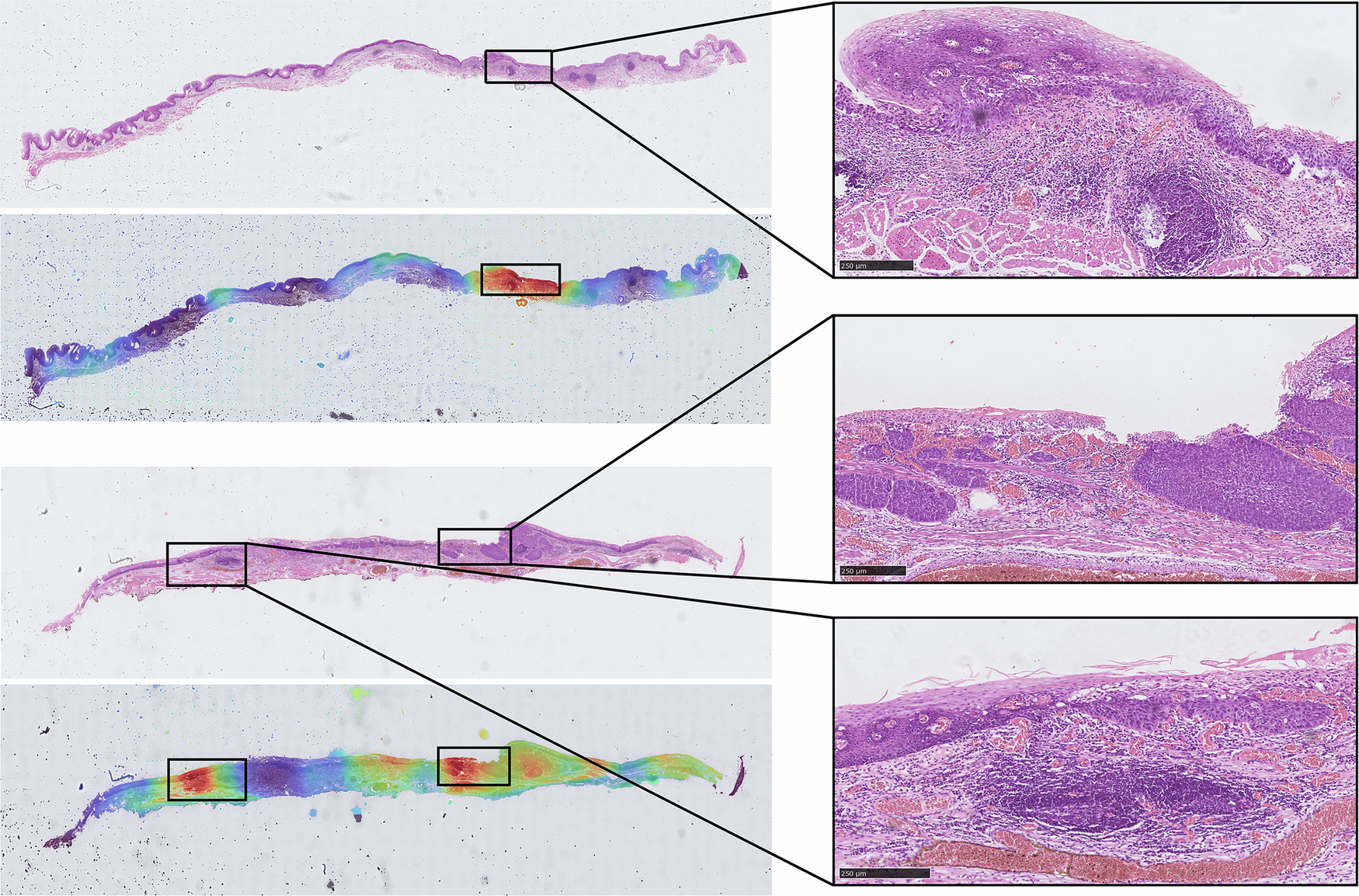 Fig. 5: Representative attention heatmaps generated from the hierarchical GNN model.