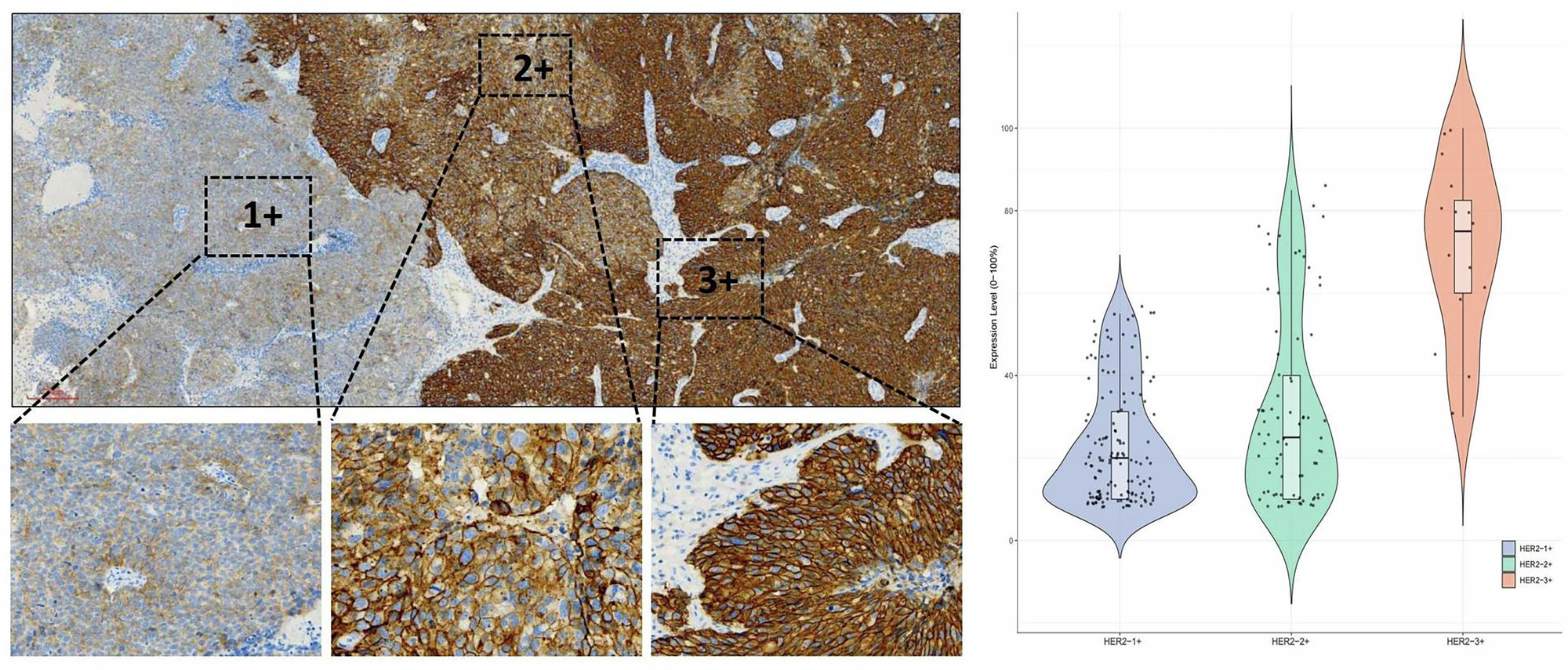 Fig. 3: Intratumoral heterogeneity of HER2 expression.