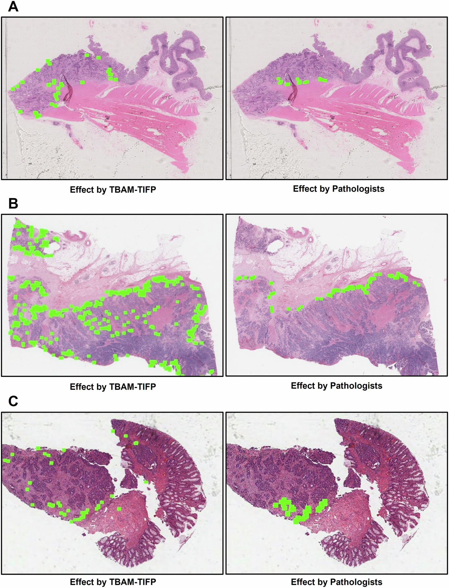 Fig. 9: Effect comparisons of TB annotations in WSIs from different datasets.