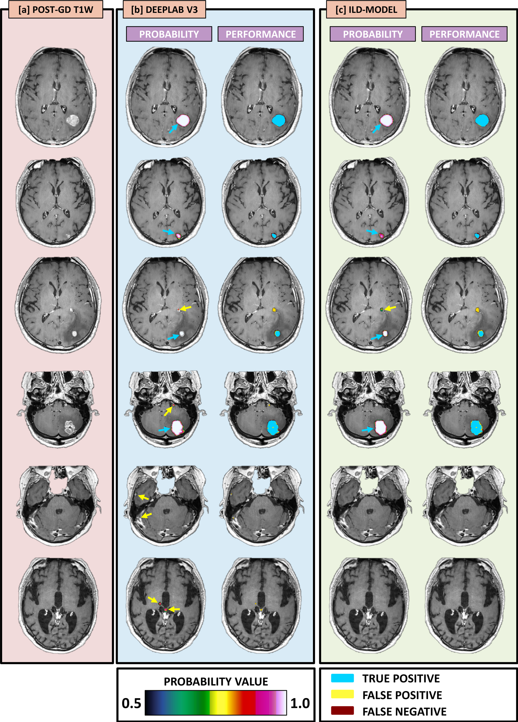 Handling Missing Mri Sequences In Deep Learning Segmentation Of Brain Metastases A Multicenter Study Npj Digital Medicine