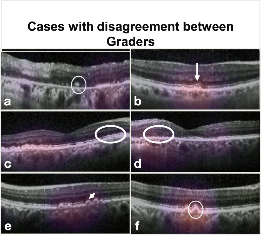 Fig. 5: Composite of B-scan images of example cases with disagreement between multiple graders.
