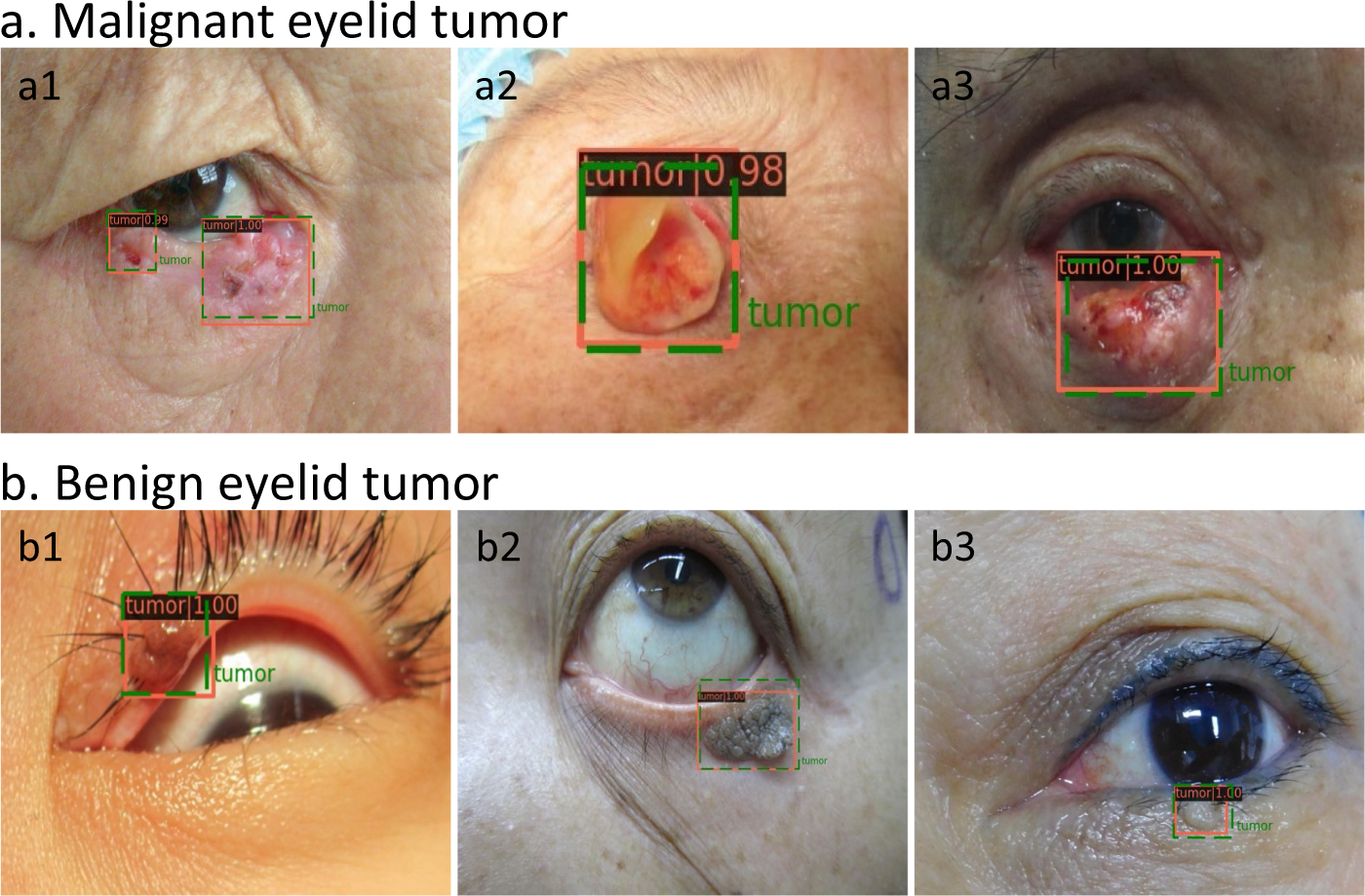 eyelid diseases