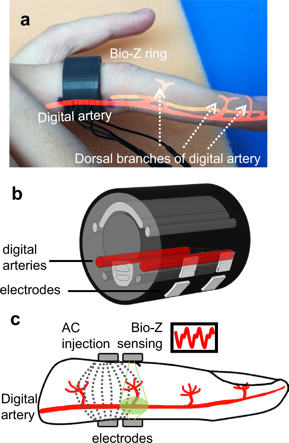 Continuous cuffless blood pressure monitoring with a wearable ring  bioimpedance device