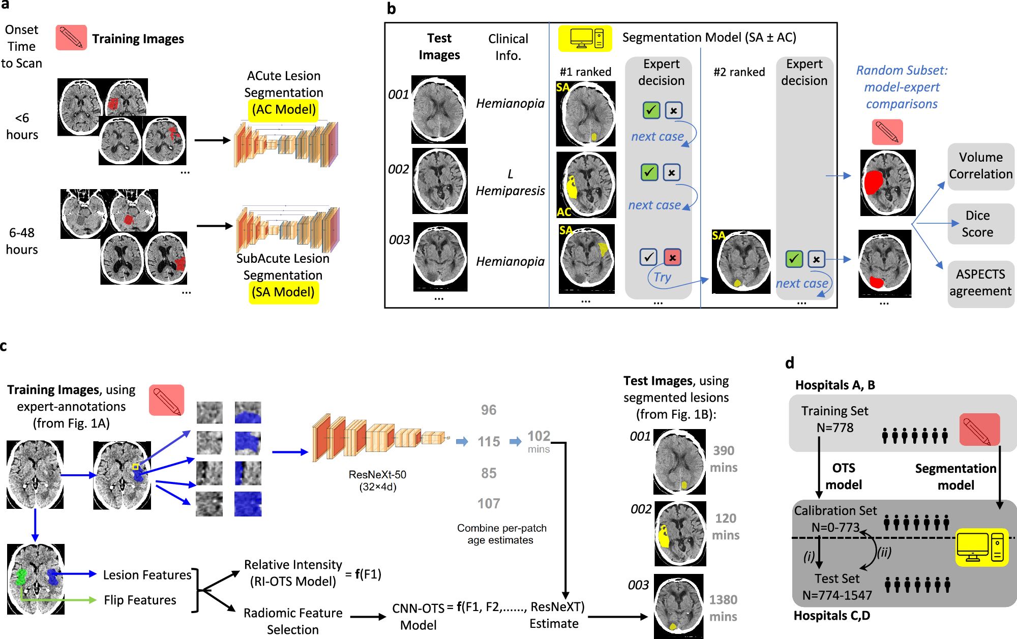 新しいAI脳卒中脳スキャン測定は、現在の方法よりも2倍正確である(New AI stroke brain scan readings are twice as accurate as current method)