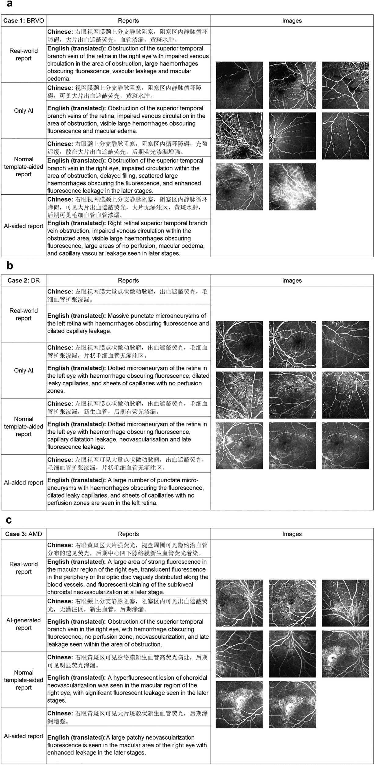 Fig. 4: Illustrations of the real-world, only AI, normal template-aided, AI-aided reports from 3 cases.
