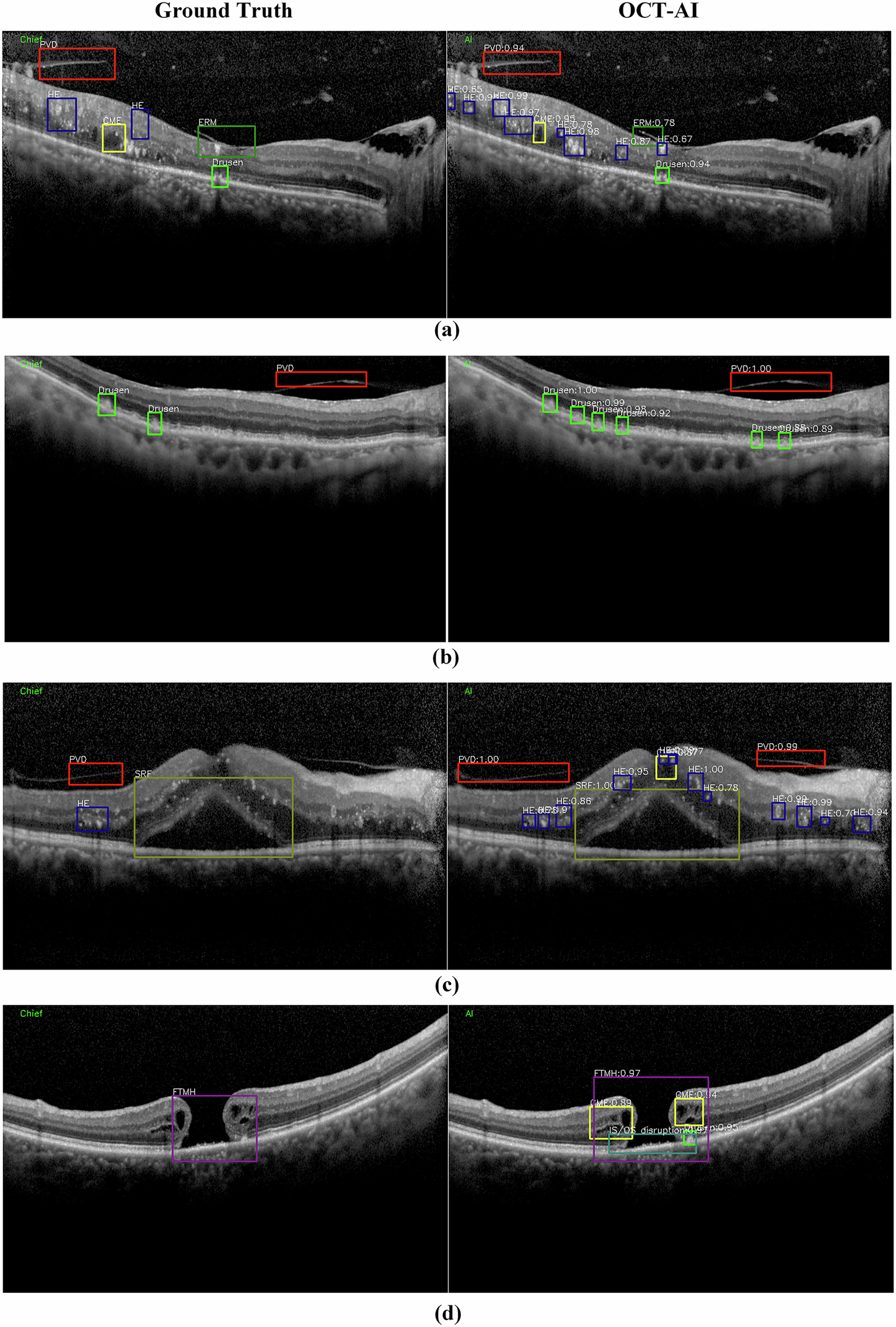 Fig. 1: Four example results of retinal anomalies detection.