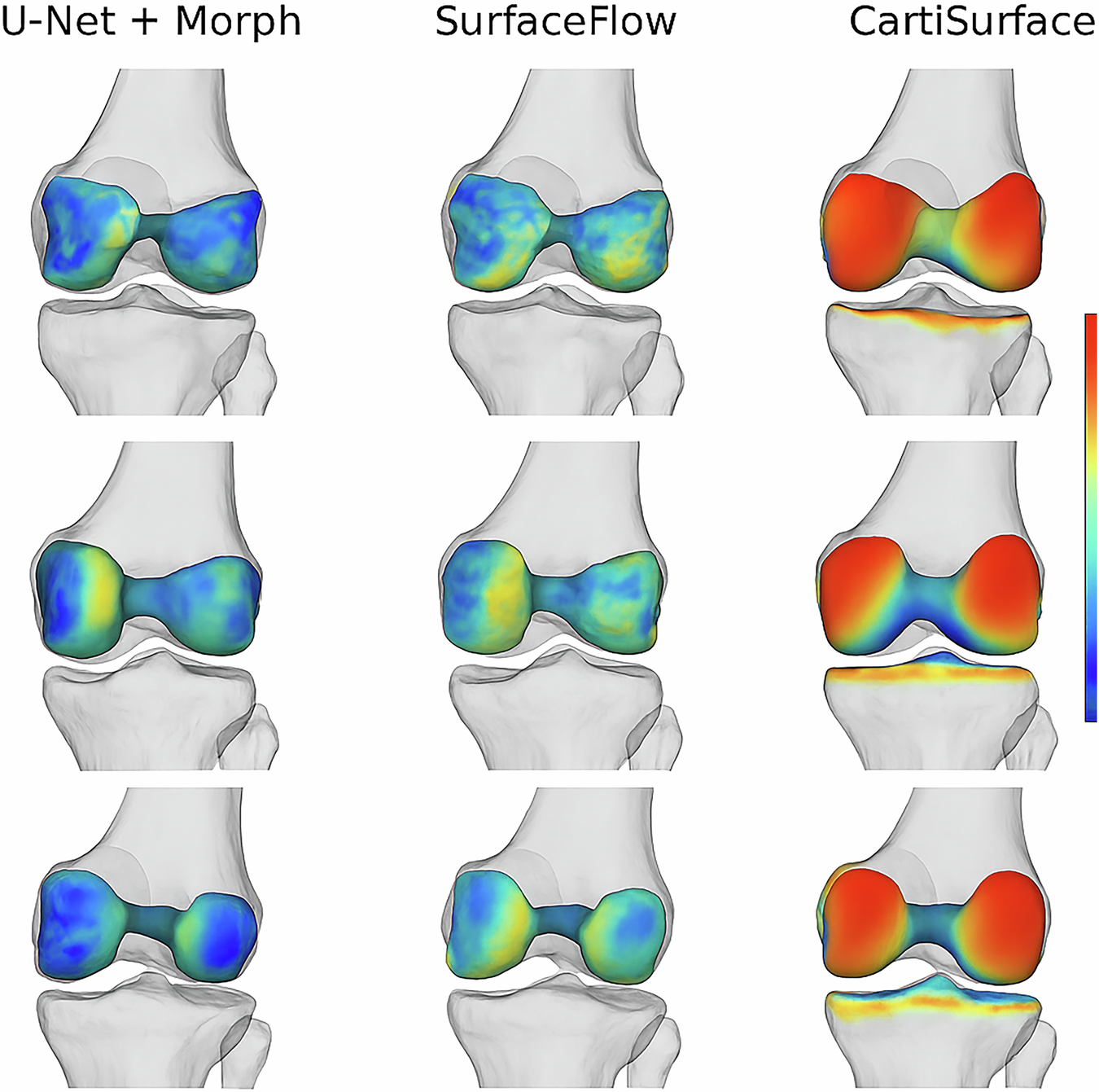 Fig. 5: 3D visualization of cartilage thickness heatmaps mapped onto reconstructed bone surfaces.