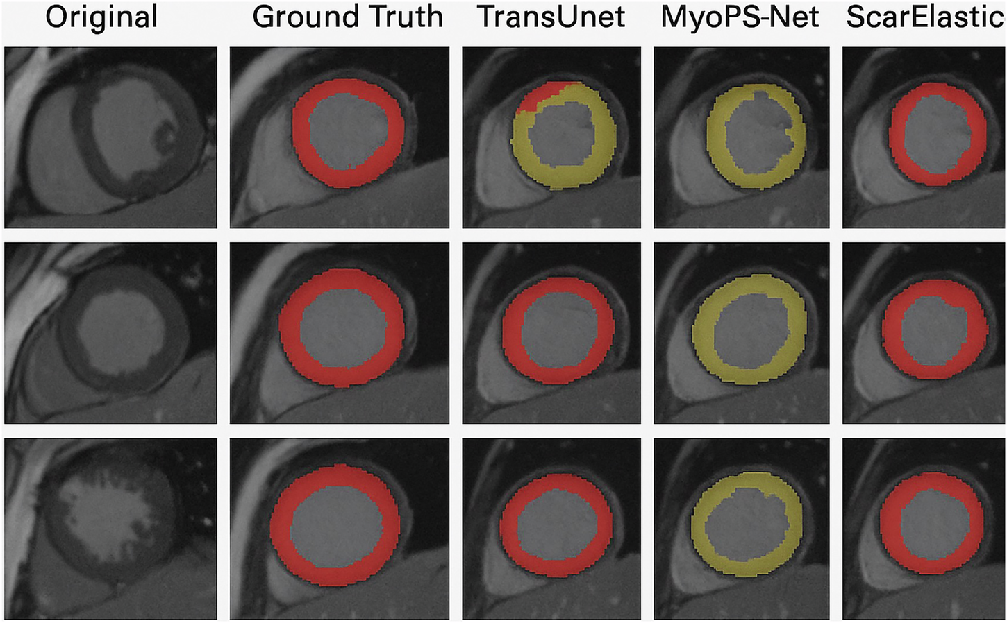 Fig. 1: Qualitative comparison of lesion localization and segmentation across representative LGE-CMR cases.