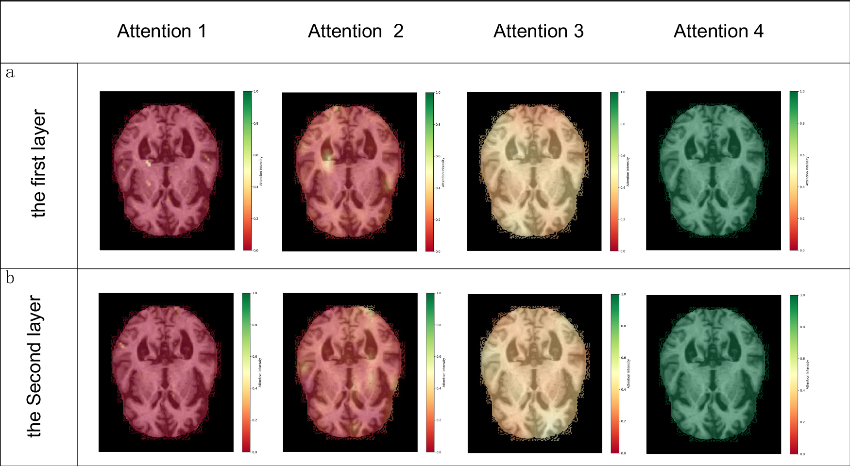 Fig. 7: This figure visualizes the four attention heads in the first and second layers of CVTC model processing brain MRI images.