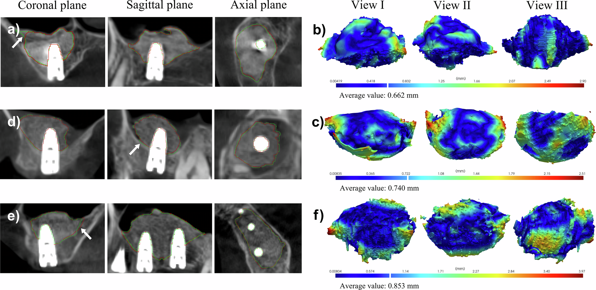 Fig. 5: Differences and distance error analysis between manually annotated and SA-ai automatically segmented intrasinus bone graft material.