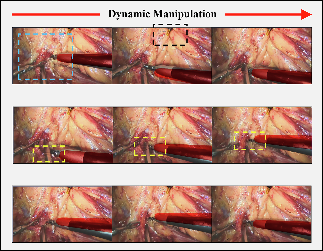 Fig. 9: Real-time field-of-view fusion and intraoperative visualization during Renal Hilar Dissection.