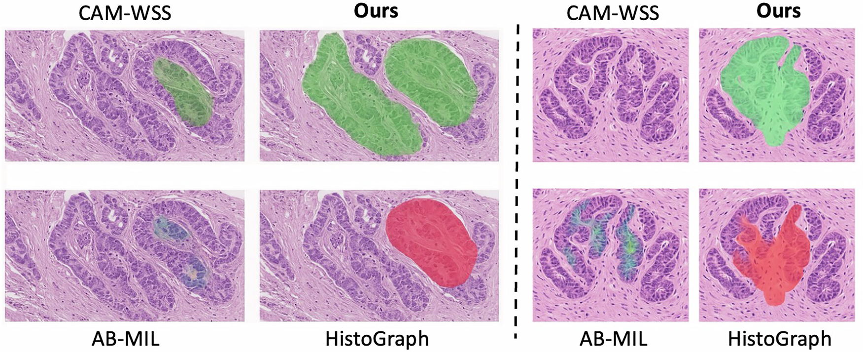 Fig. 3: Qualitative comparison of segmentation results on two representative gastric adenocarcinoma cases.