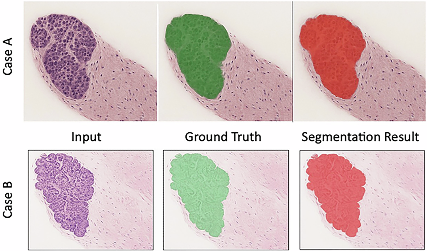 Fig. 4: High-fidelity segmentation results of our Geo-MIL framework on two distinct cases.