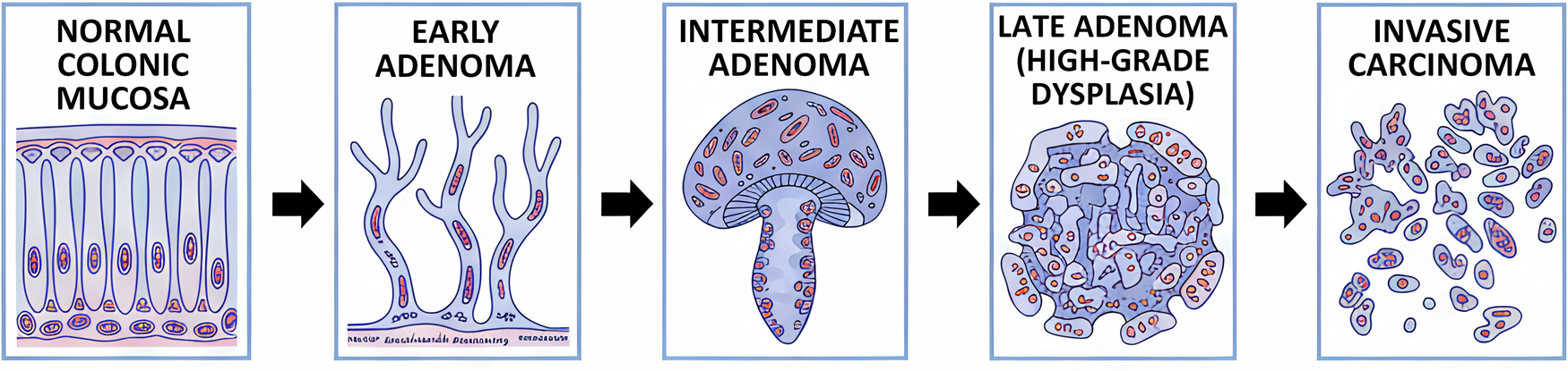 Fig. 2: Schematic of the Adenoma carcinoma sequence.